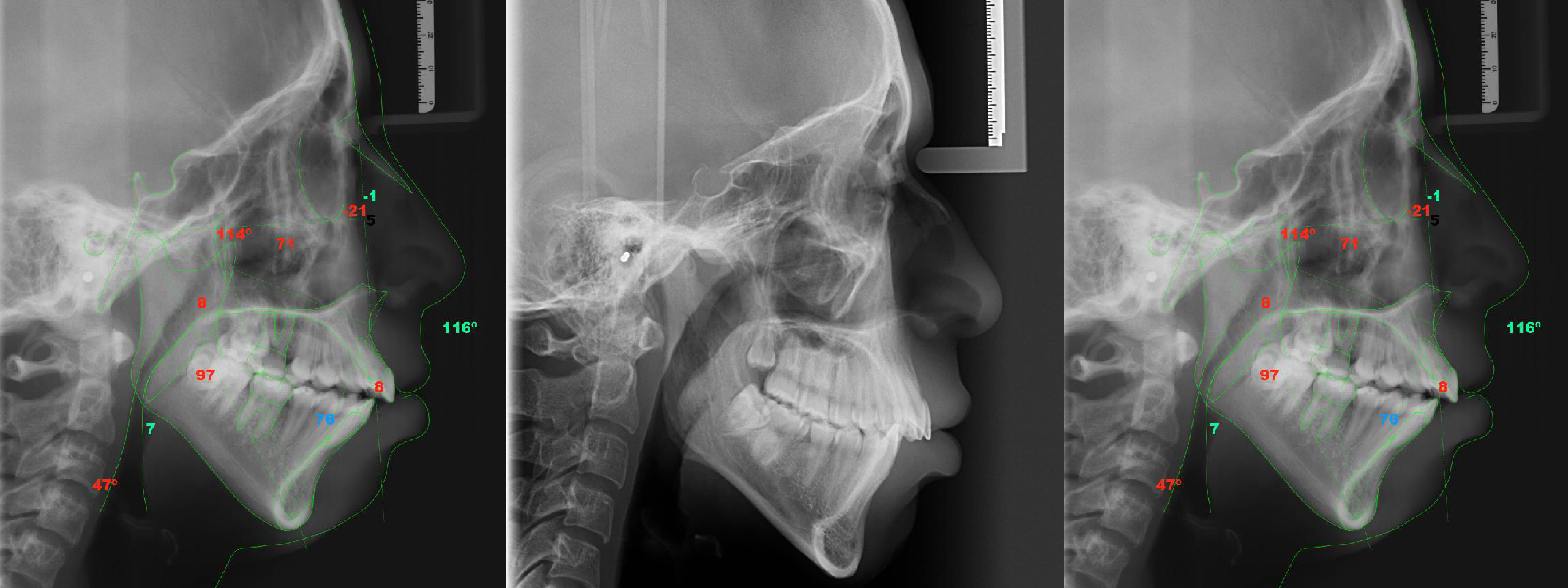 Radiografía Intrabucal